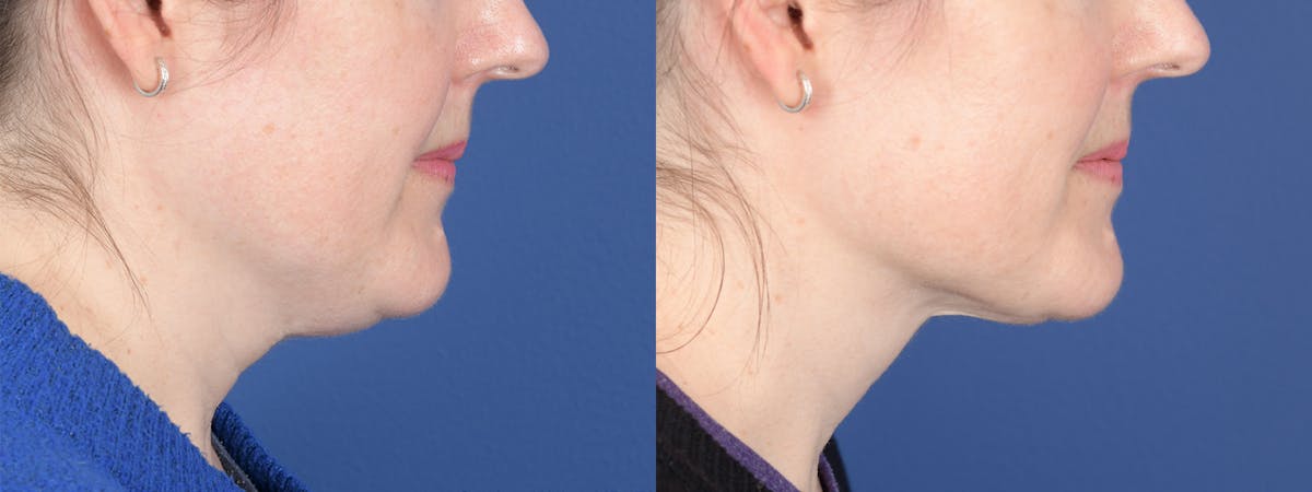 Necklift Before & After Gallery - Patient 210381 - Image 5