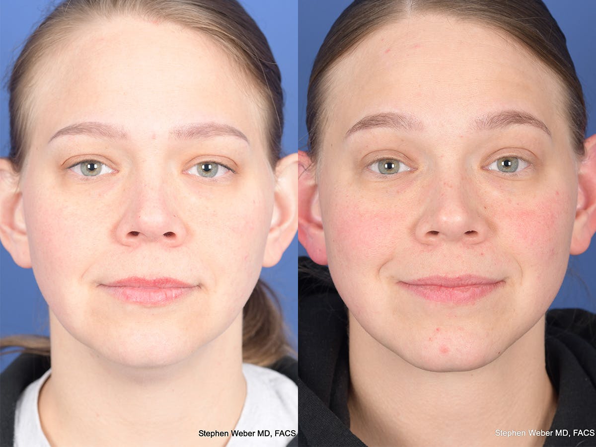 Necklift Before & After Gallery - Patient 289538 - Image 1