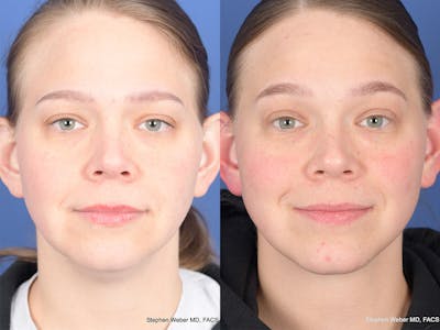 Necklift Before & After Gallery - Patient 289538 - Image 1