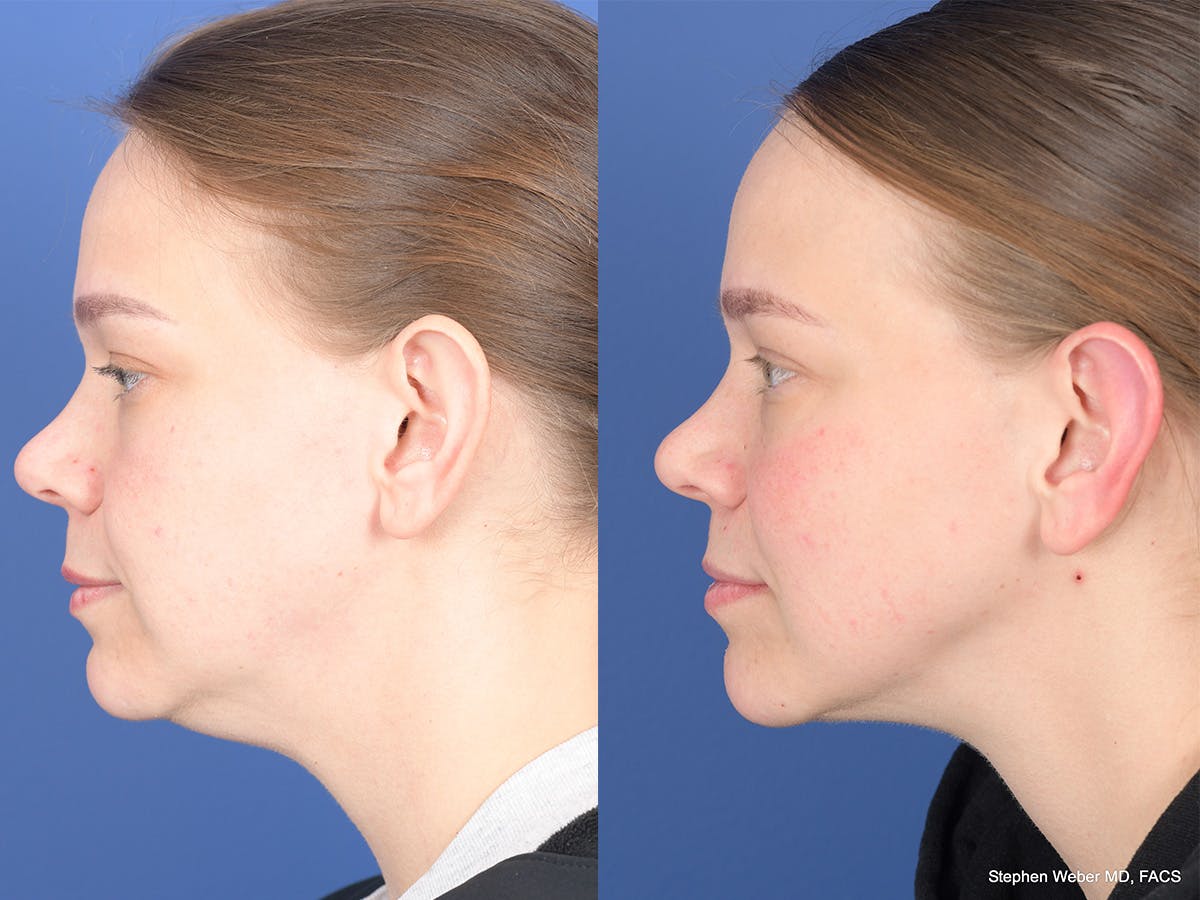 Necklift Before & After Gallery - Patient 289538 - Image 2