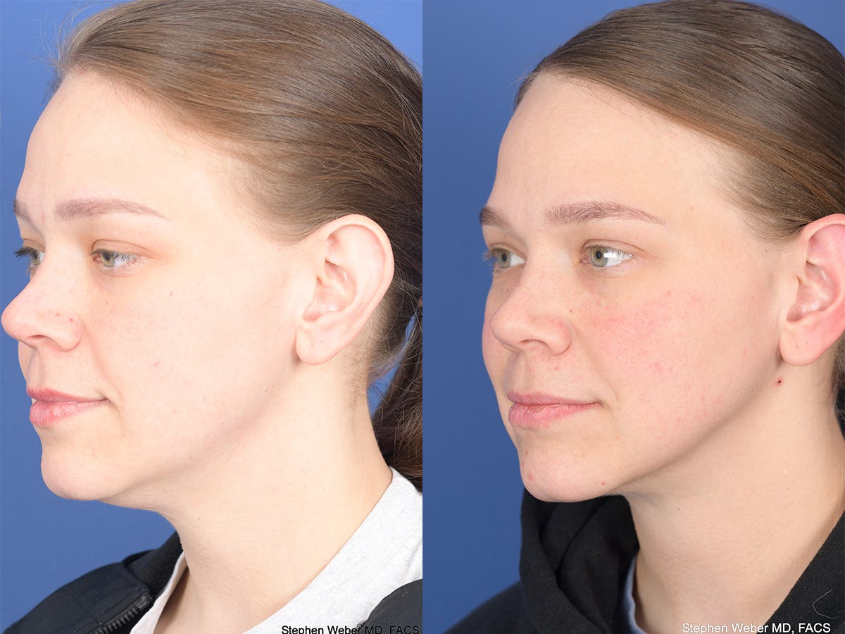Necklift Before & After Gallery - Patient 289538 - Image 3