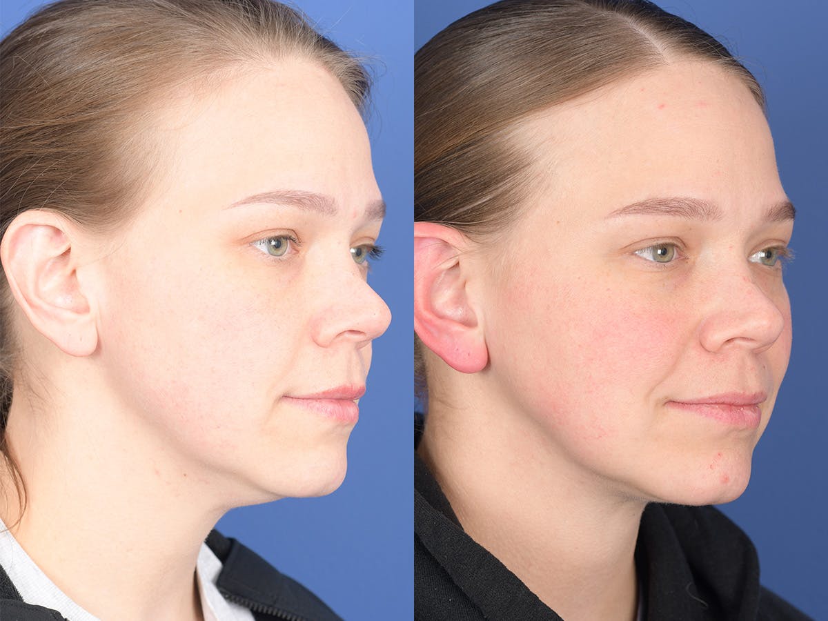 Necklift Before & After Gallery - Patient 289538 - Image 4