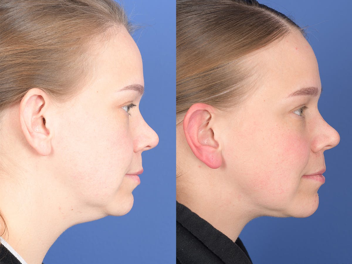 Necklift Before & After Gallery - Patient 289538 - Image 5