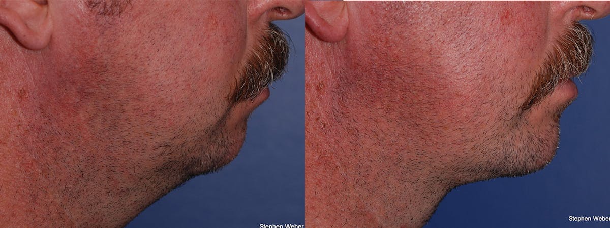 Necklift Before & After Gallery - Patient 294875 - Image 1