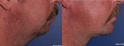 Necklift Before & After Gallery - Patient 294875 - Image 1