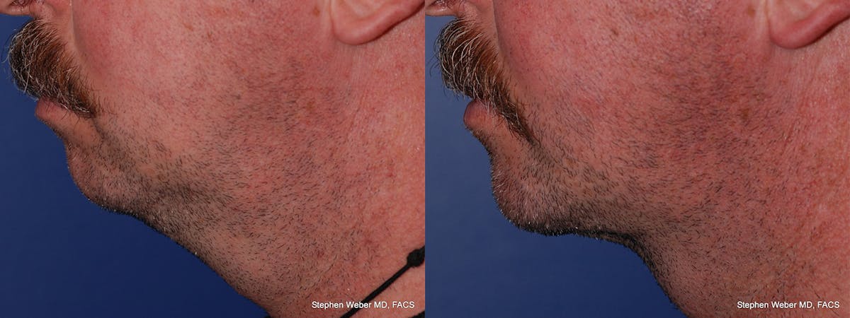 Necklift Before & After Gallery - Patient 294875 - Image 2