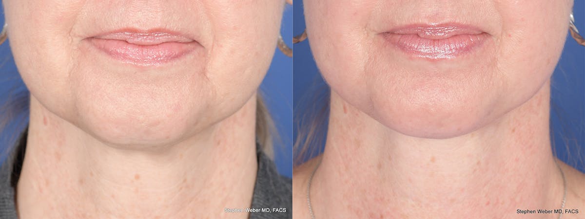 Necklift Before & After Gallery - Patient 174498 - Image 1