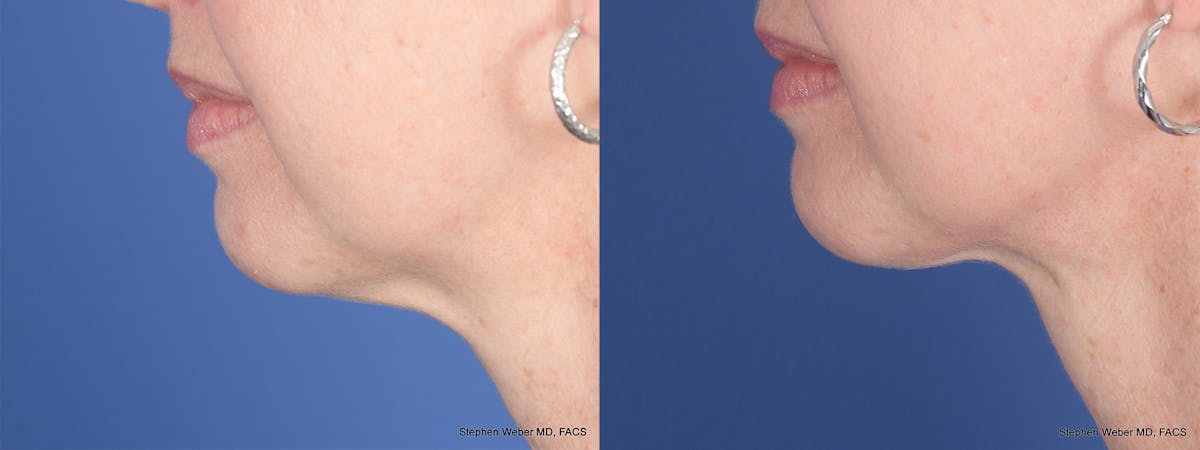 Necklift Before & After Gallery - Patient 174498 - Image 2