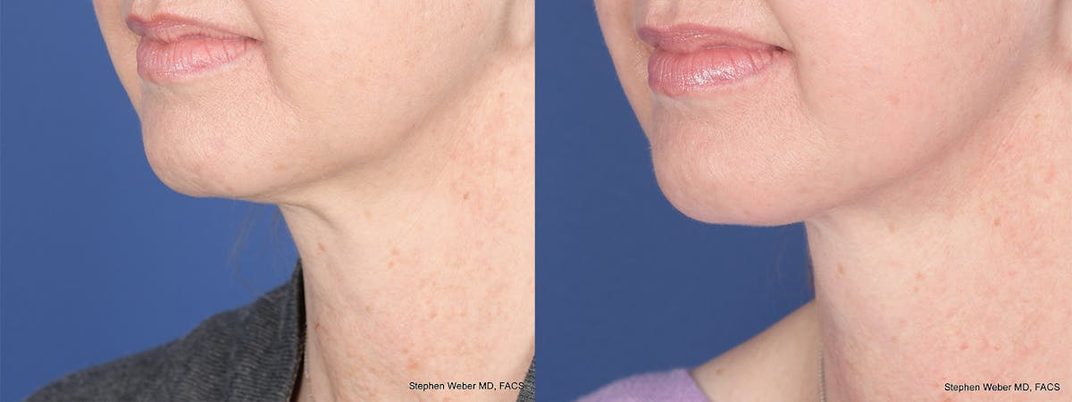 Necklift Before & After Gallery - Patient 174498 - Image 3