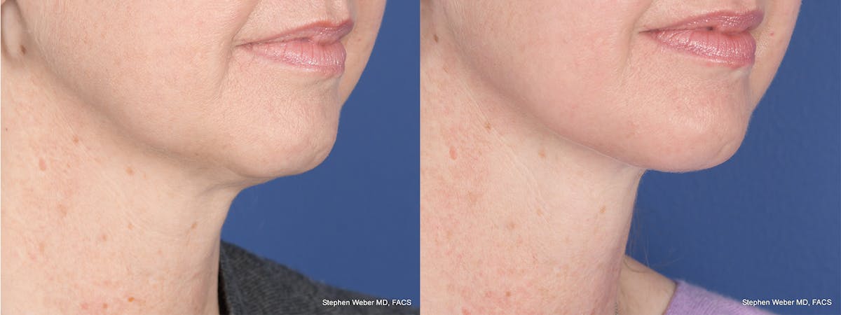 Necklift Before & After Gallery - Patient 174498 - Image 4