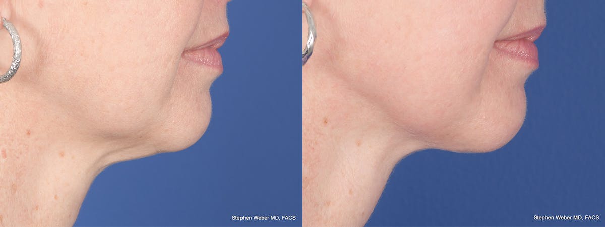 Necklift Before & After Gallery - Patient 174498 - Image 5