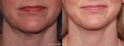 Necklift Before & After Gallery - Patient 331165 - Image 1