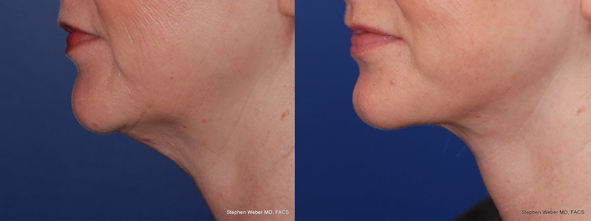 Necklift Before & After Gallery - Patient 331165 - Image 2