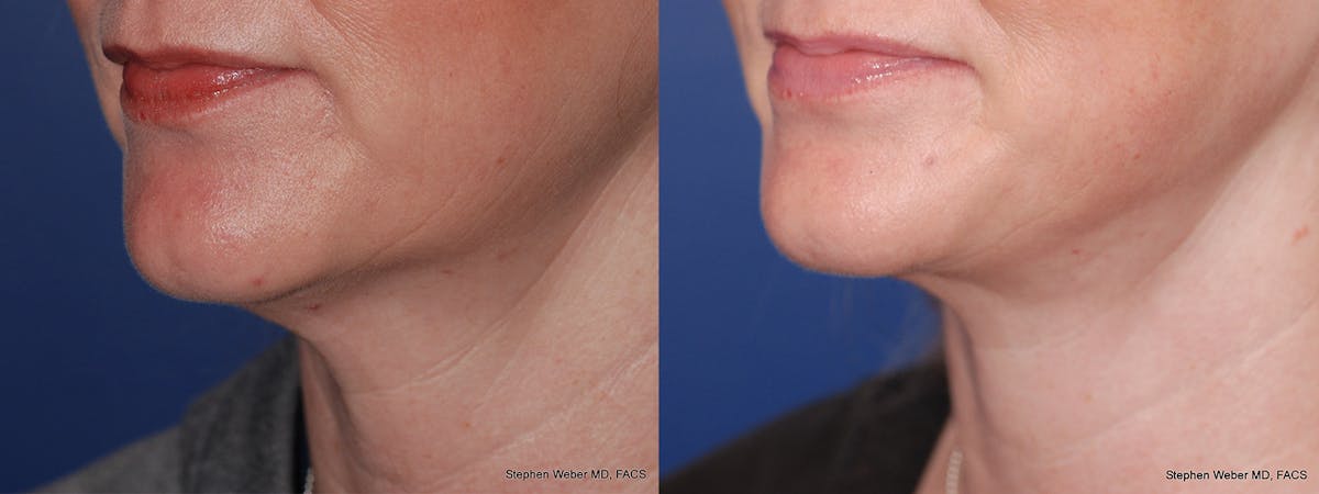 Necklift Before & After Gallery - Patient 331165 - Image 3