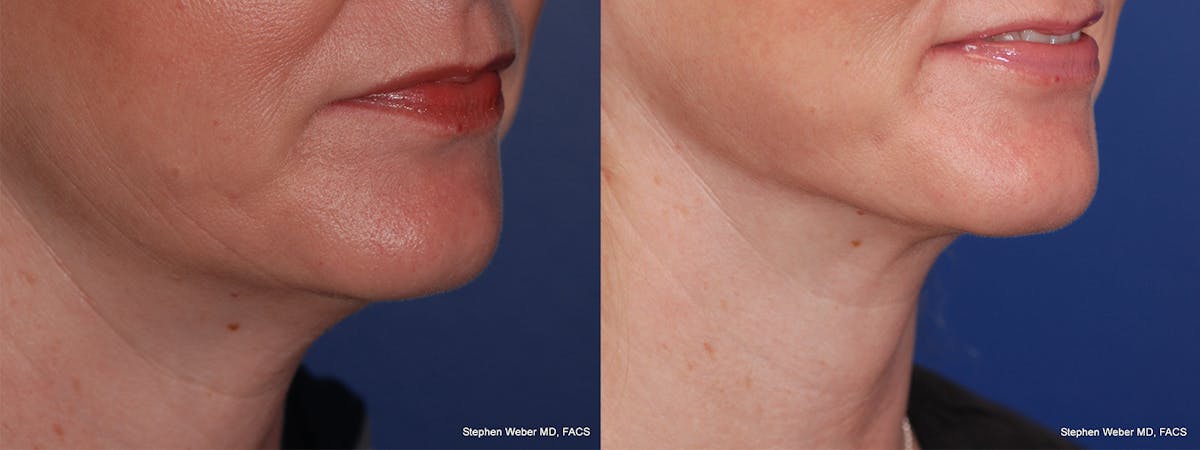 Necklift Before & After Gallery - Patient 331165 - Image 4