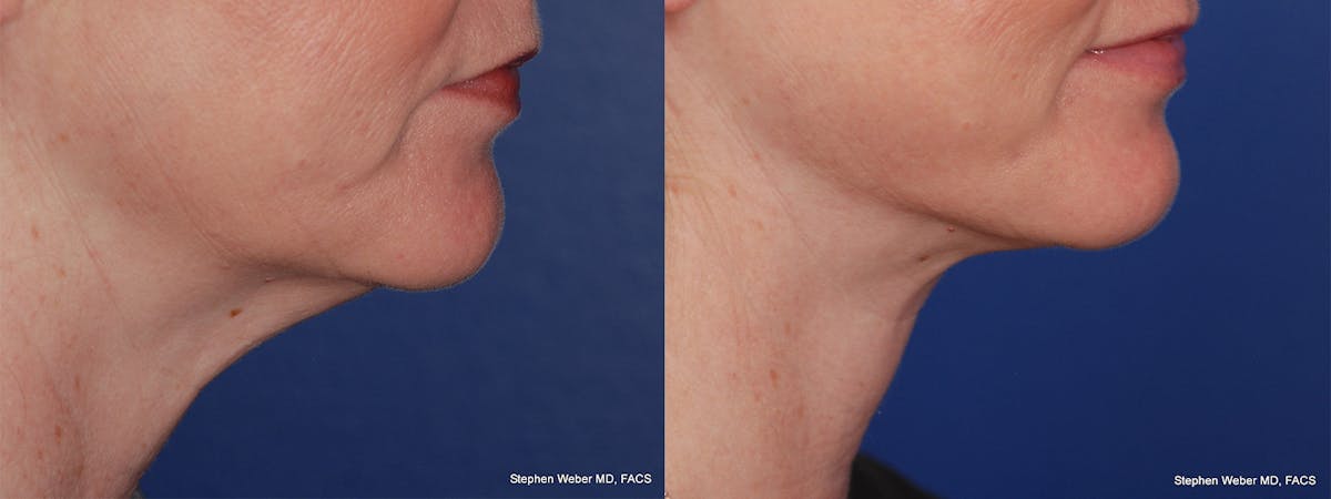 Necklift Before & After Gallery - Patient 331165 - Image 5