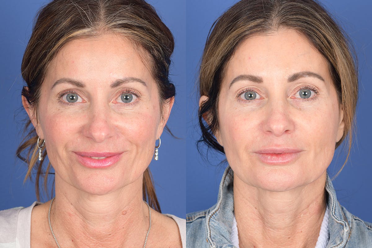 Necklift Before & After Gallery - Patient 299073 - Image 1