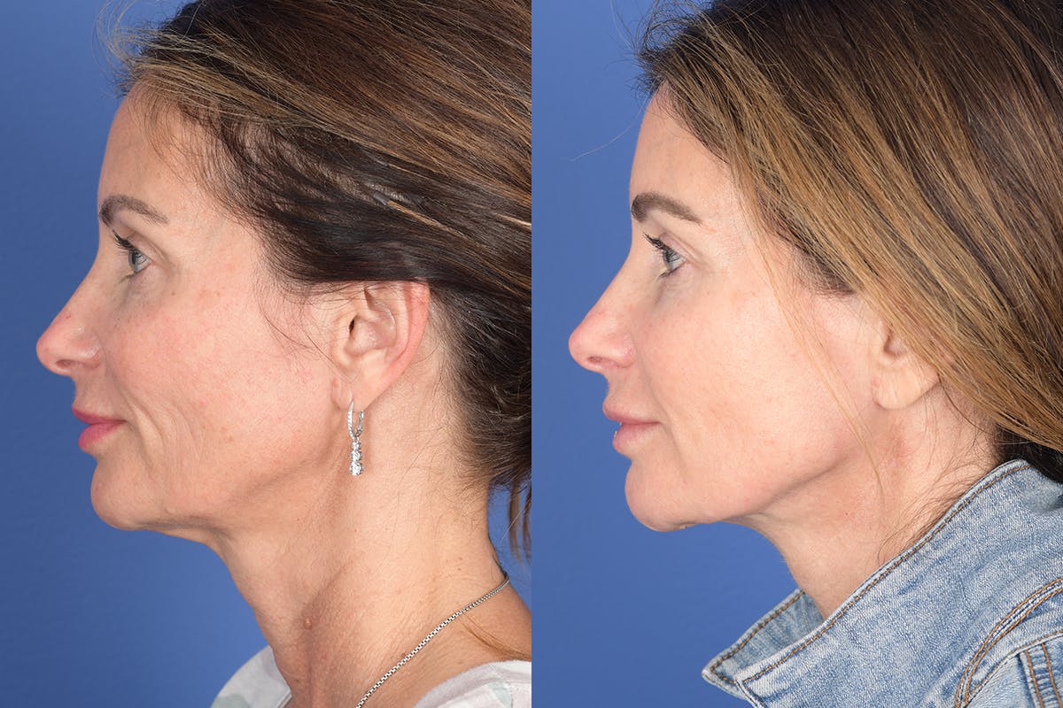 Necklift Before & After Gallery - Patient 299073 - Image 2