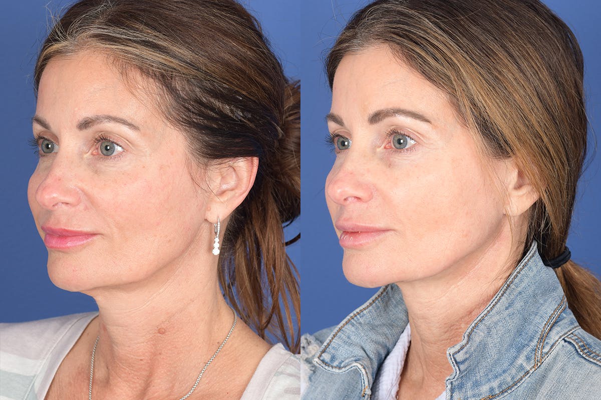 Necklift Before & After Gallery - Patient 299073 - Image 3