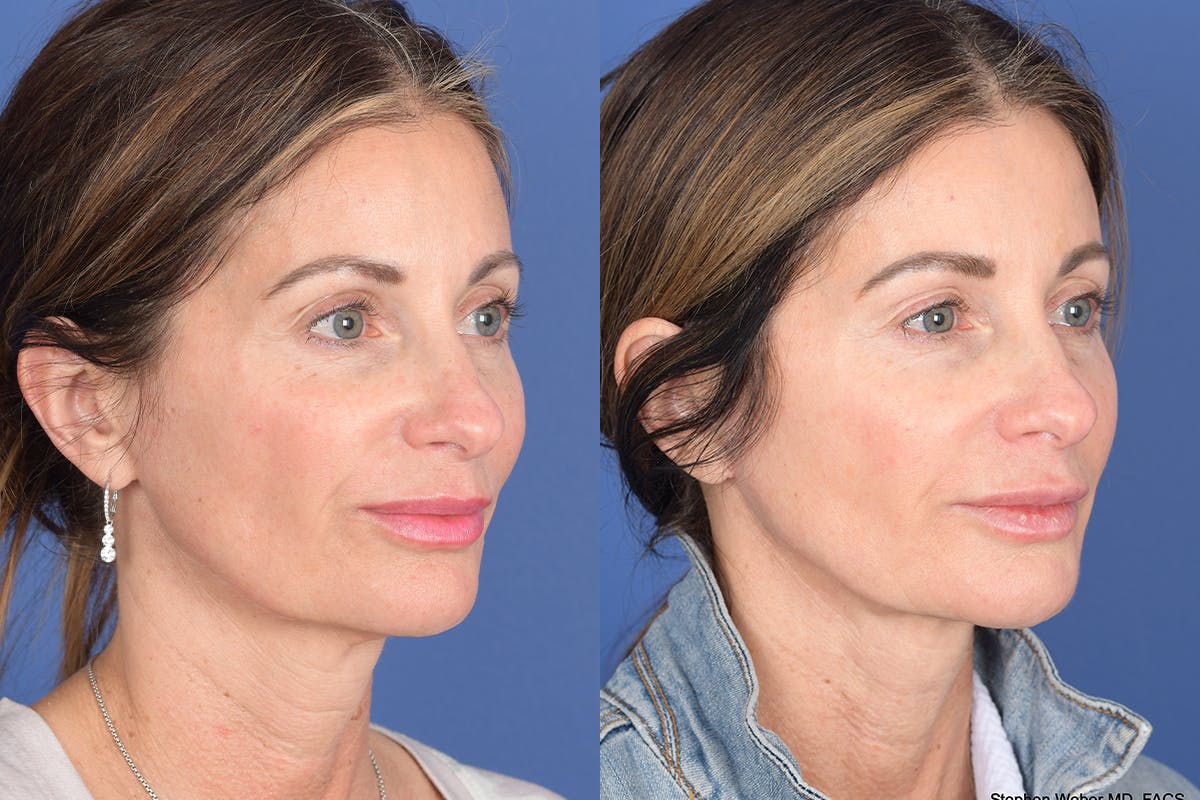 Necklift Before & After Gallery - Patient 299073 - Image 4