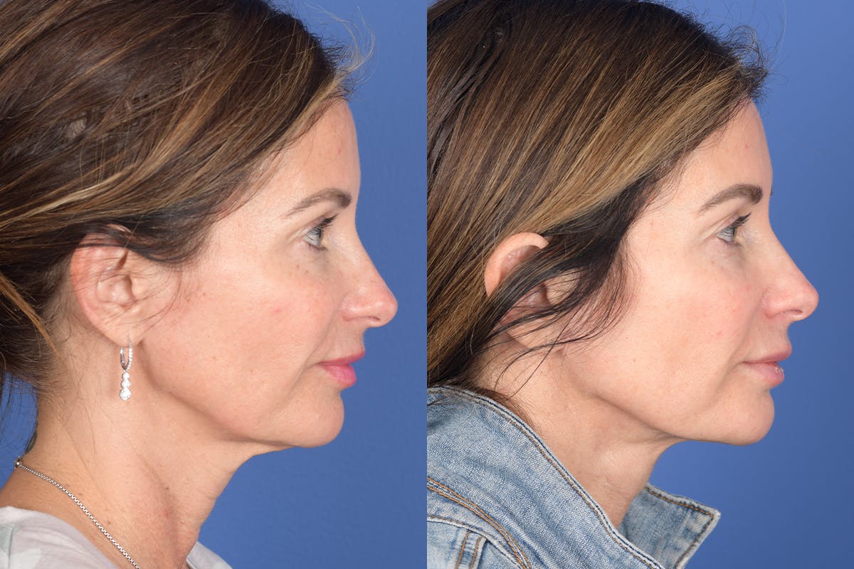 Necklift Before & After Gallery - Patient 299073 - Image 5