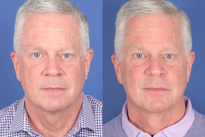 Necklift Before & After Gallery - Patient 342541 - Image 1