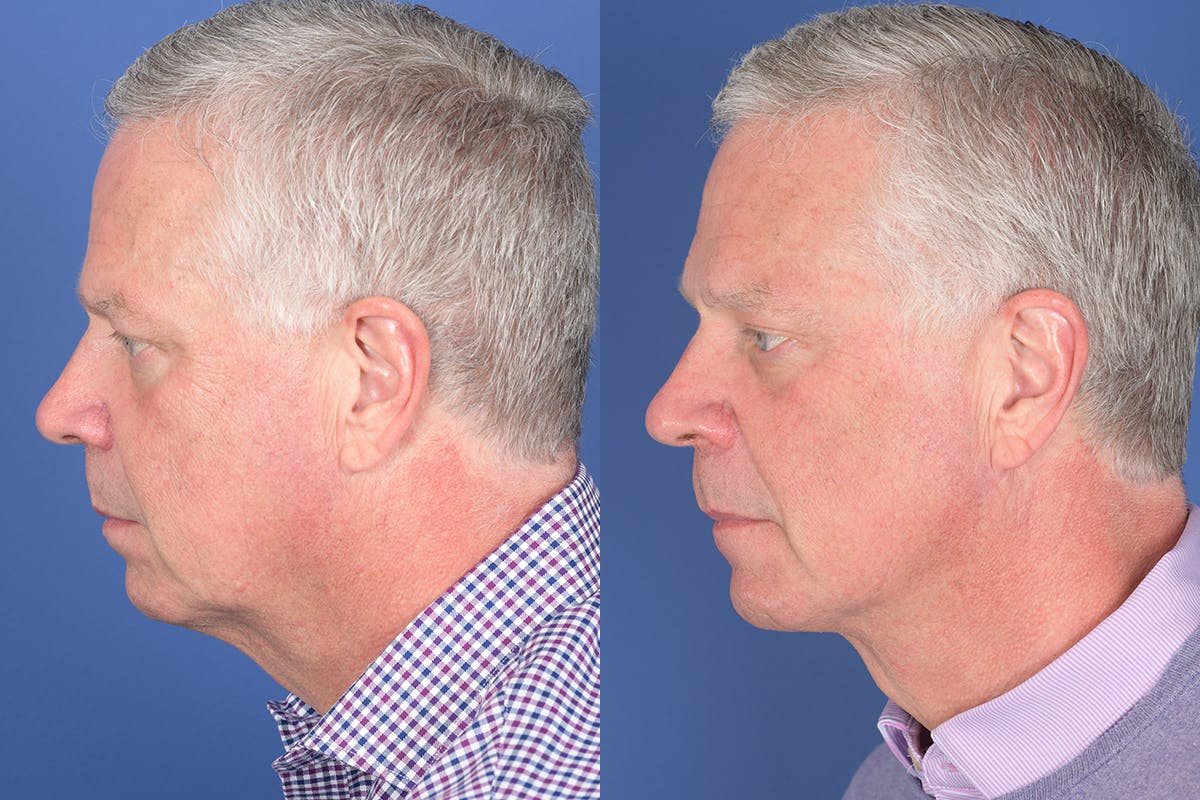 Necklift Before & After Gallery - Patient 342541 - Image 2