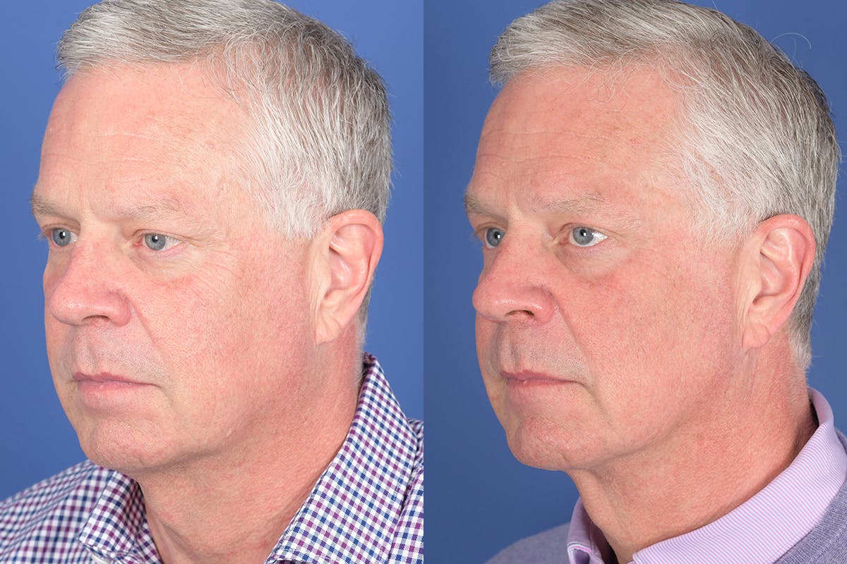 Necklift Before & After Gallery - Patient 342541 - Image 3