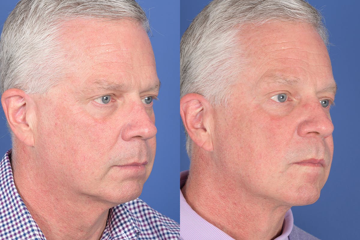 Necklift Before & After Gallery - Patient 342541 - Image 4