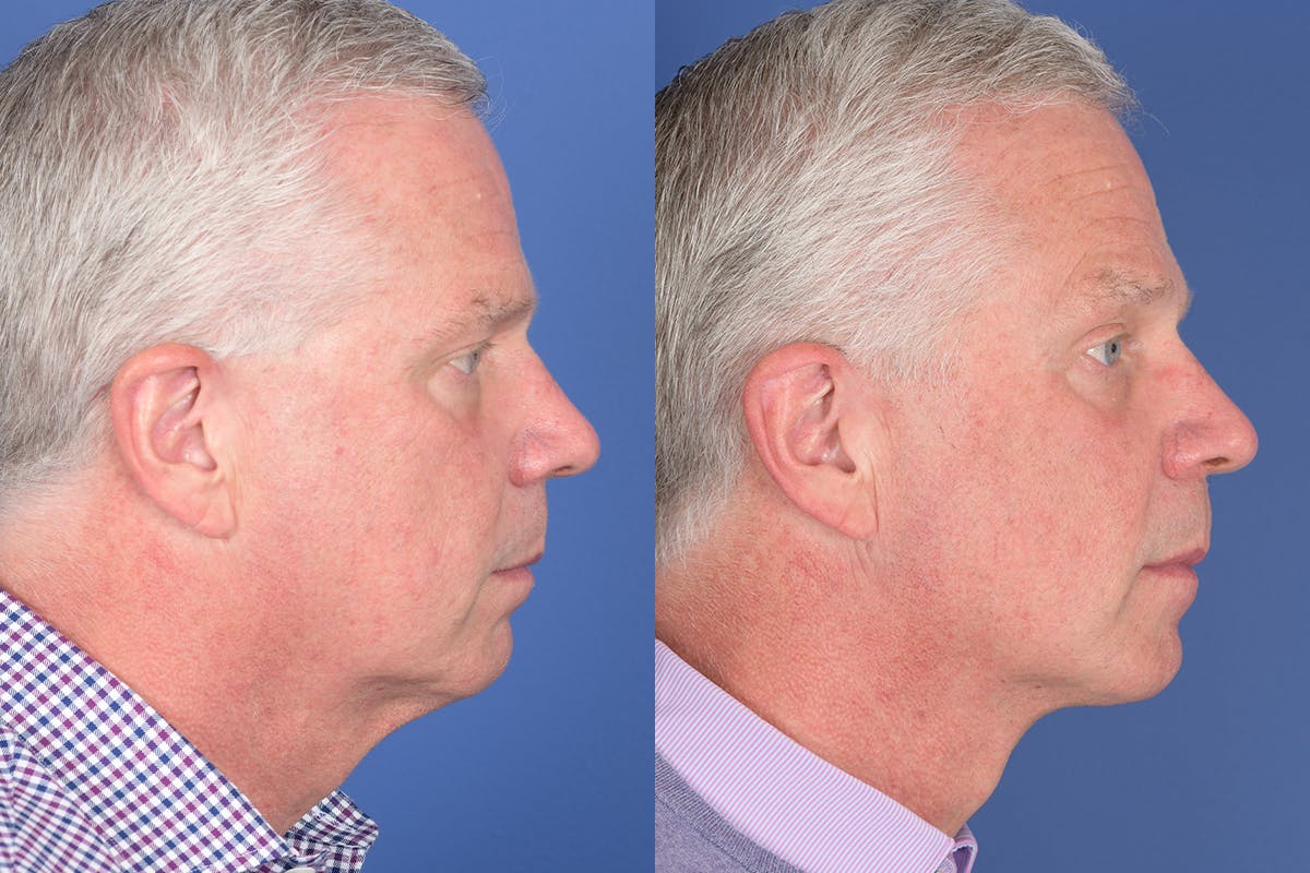 Necklift Before & After Gallery - Patient 342541 - Image 5