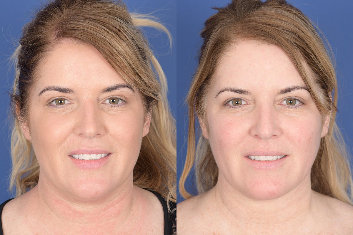 Necklift Before & After Gallery - Patient 881982 - Image 1