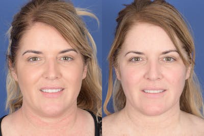 Necklift Before & After Gallery - Patient 881982 - Image 1