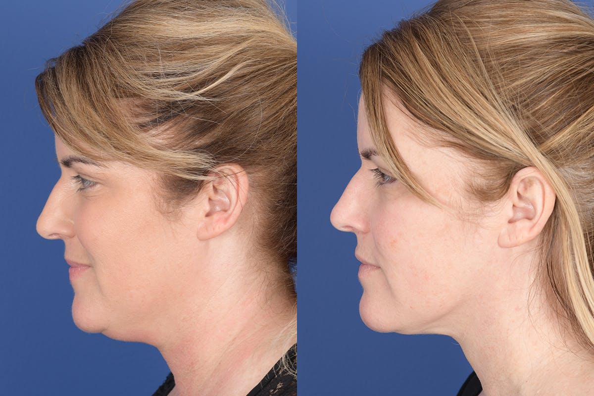 Necklift Before & After Gallery - Patient 881982 - Image 2