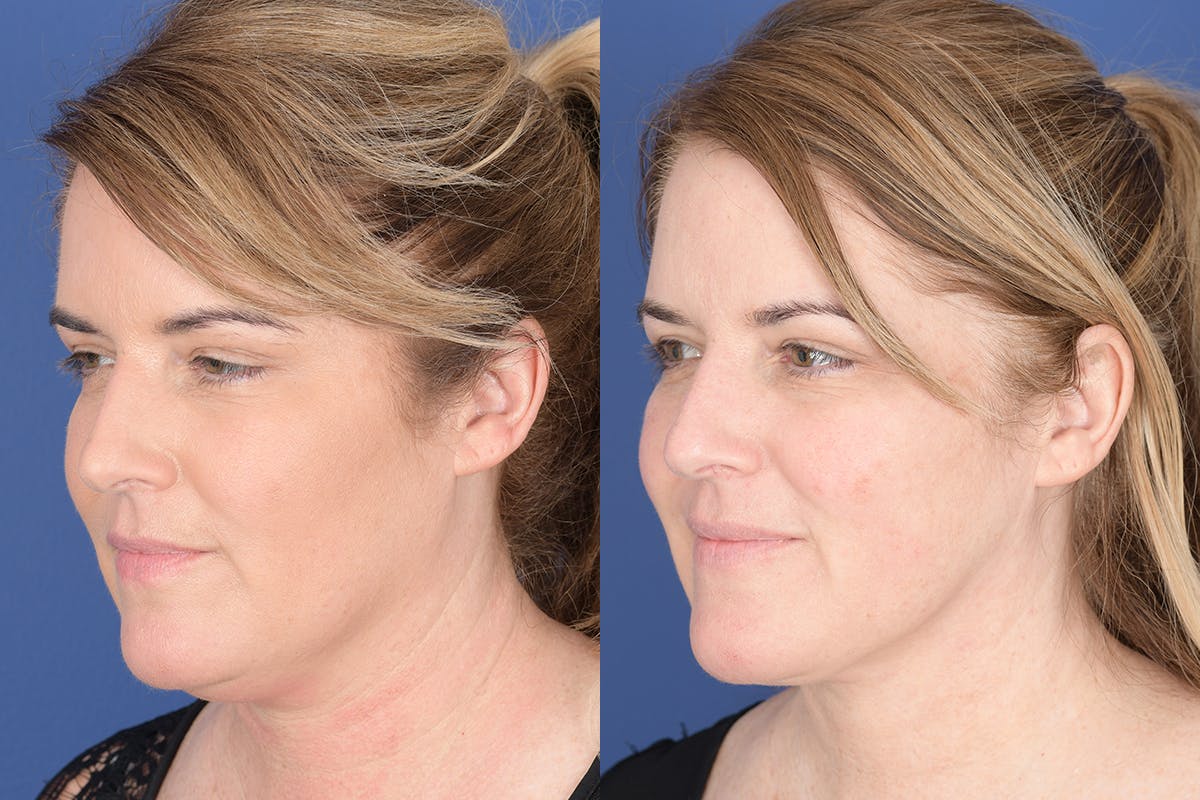Necklift Before & After Gallery - Patient 881982 - Image 3