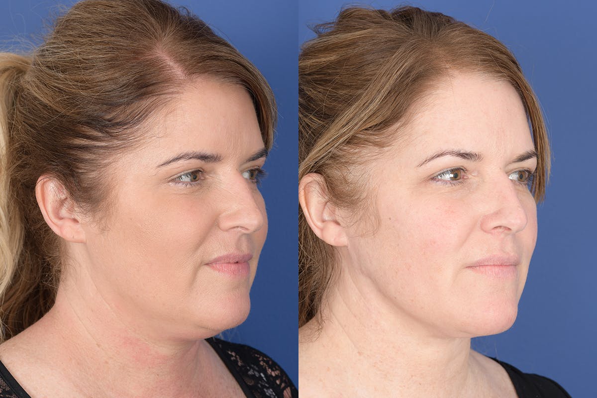 Necklift Before & After Gallery - Patient 881982 - Image 4