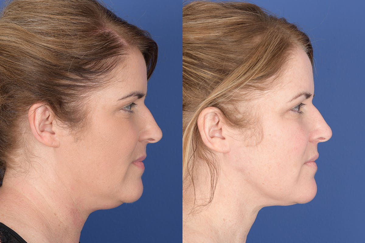 Necklift Before & After Gallery - Patient 881982 - Image 5