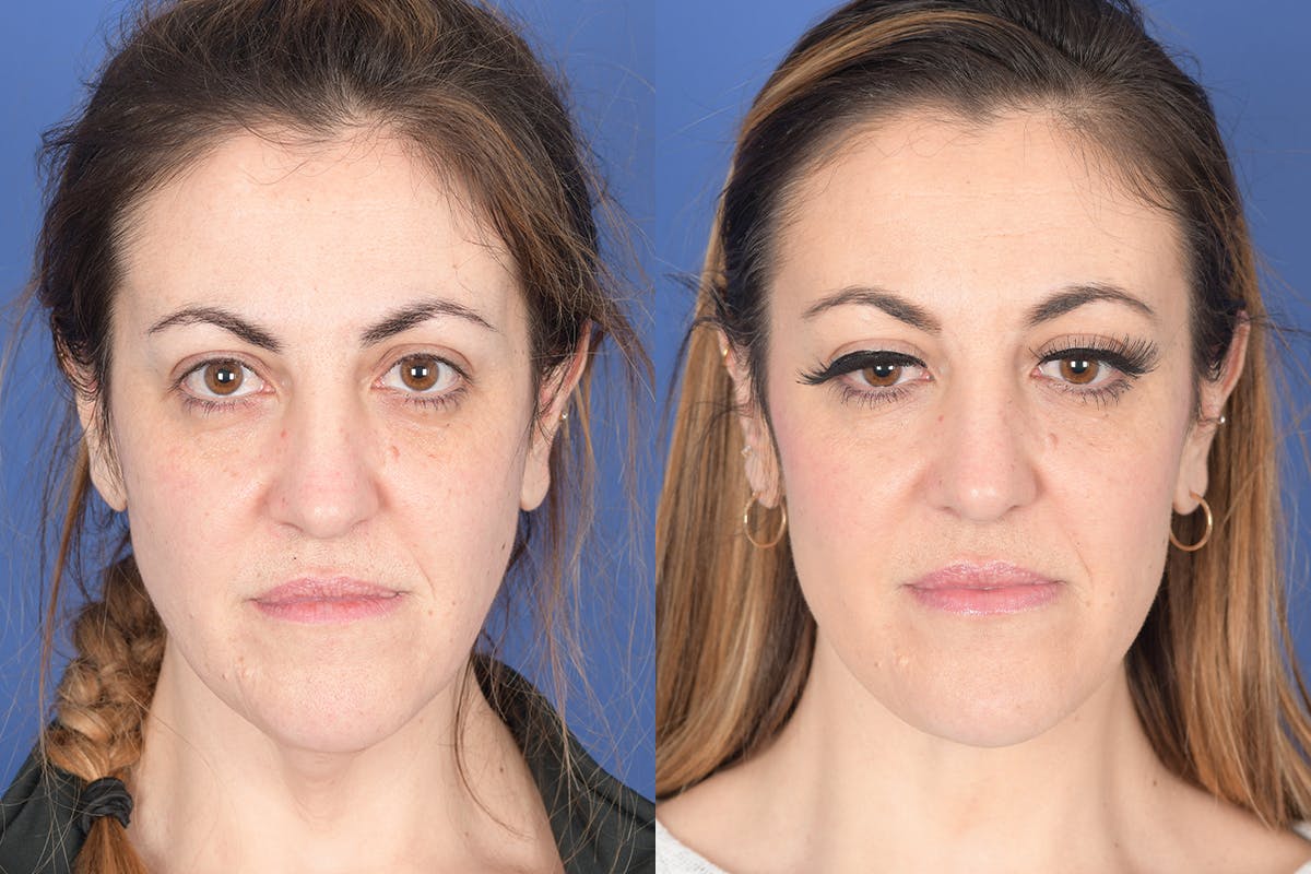 Necklift Before & After Gallery - Patient 427085 - Image 1