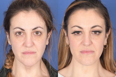 Necklift Before & After Gallery - Patient 427085 - Image 1