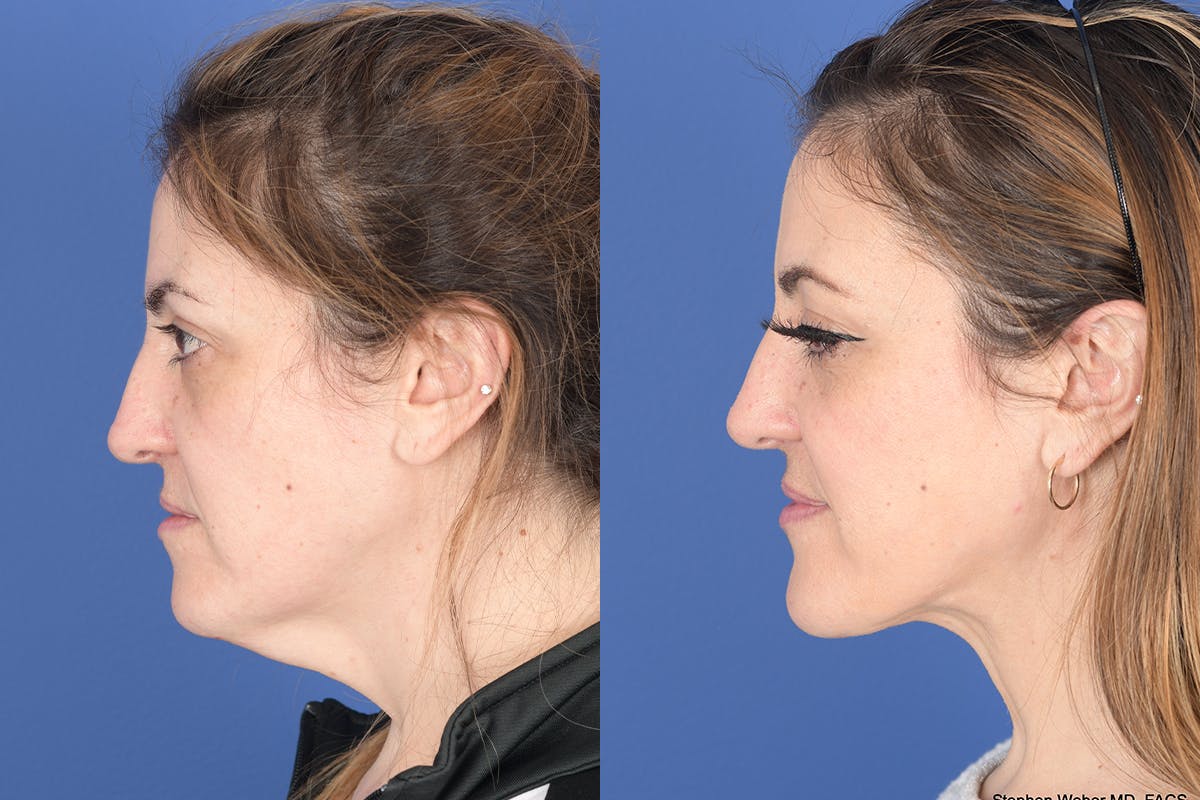 Necklift Before & After Gallery - Patient 427085 - Image 2