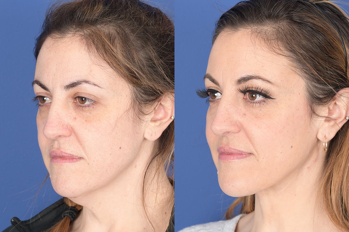 Necklift Before & After Gallery - Patient 427085 - Image 3