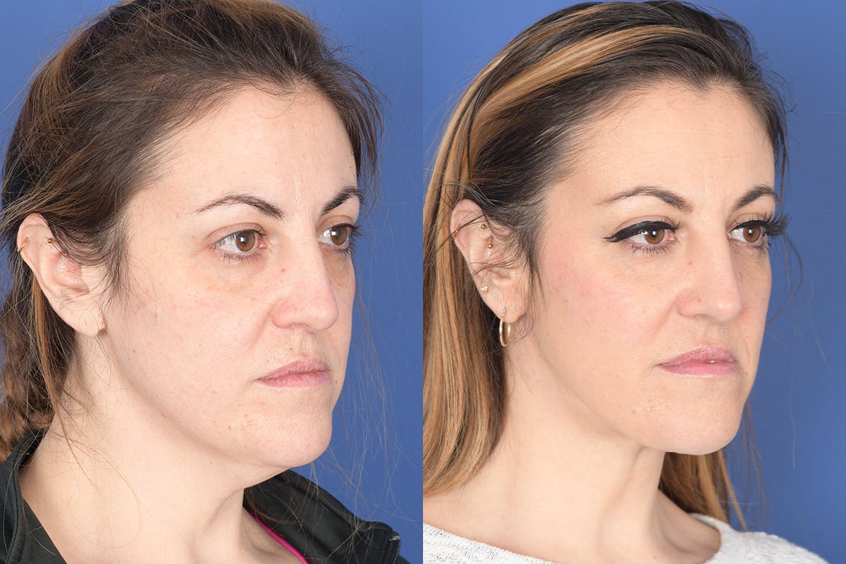 Necklift Before & After Gallery - Patient 427085 - Image 4