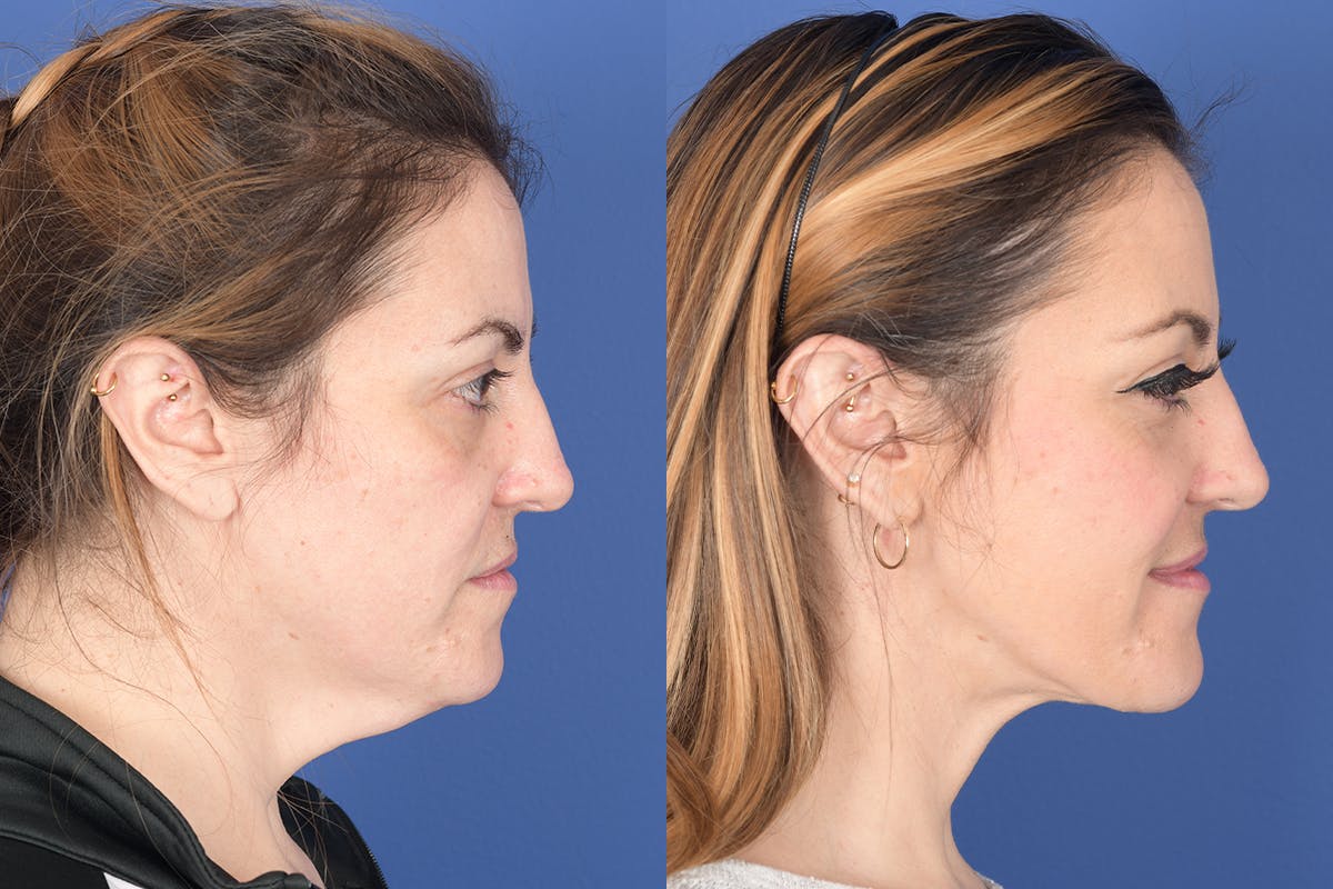 Necklift Before & After Gallery - Patient 427085 - Image 5