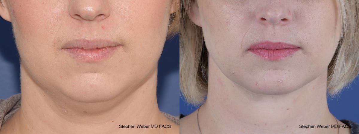 Necklift Before & After Gallery - Patient 332756 - Image 1