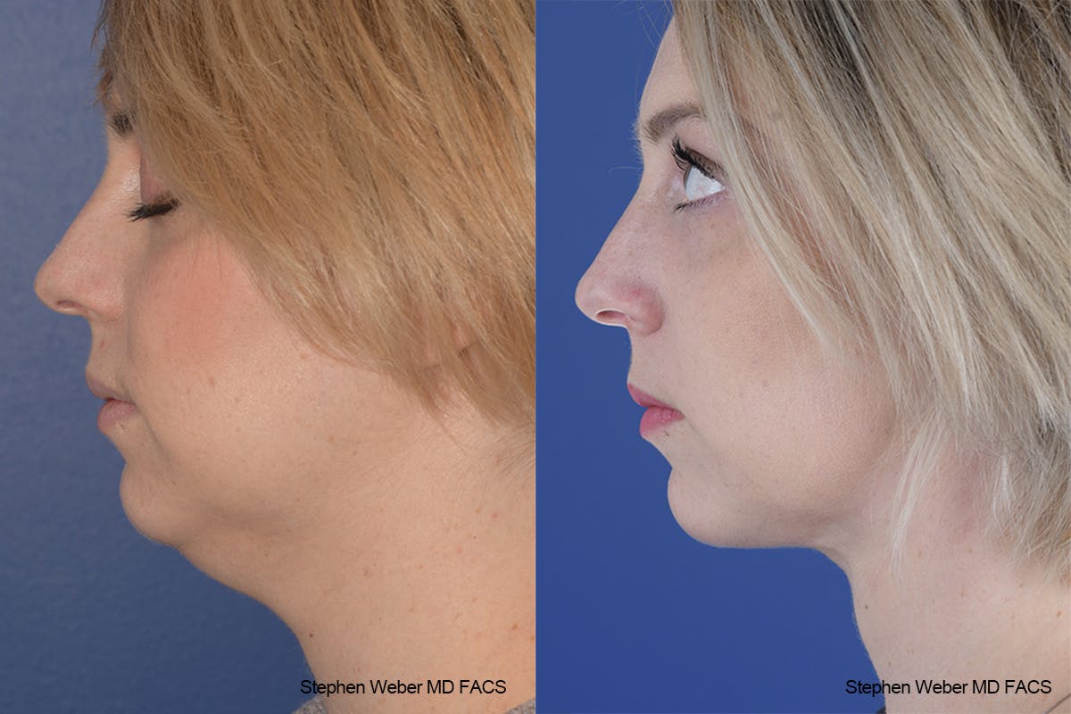 Necklift Before & After Gallery - Patient 332756 - Image 2