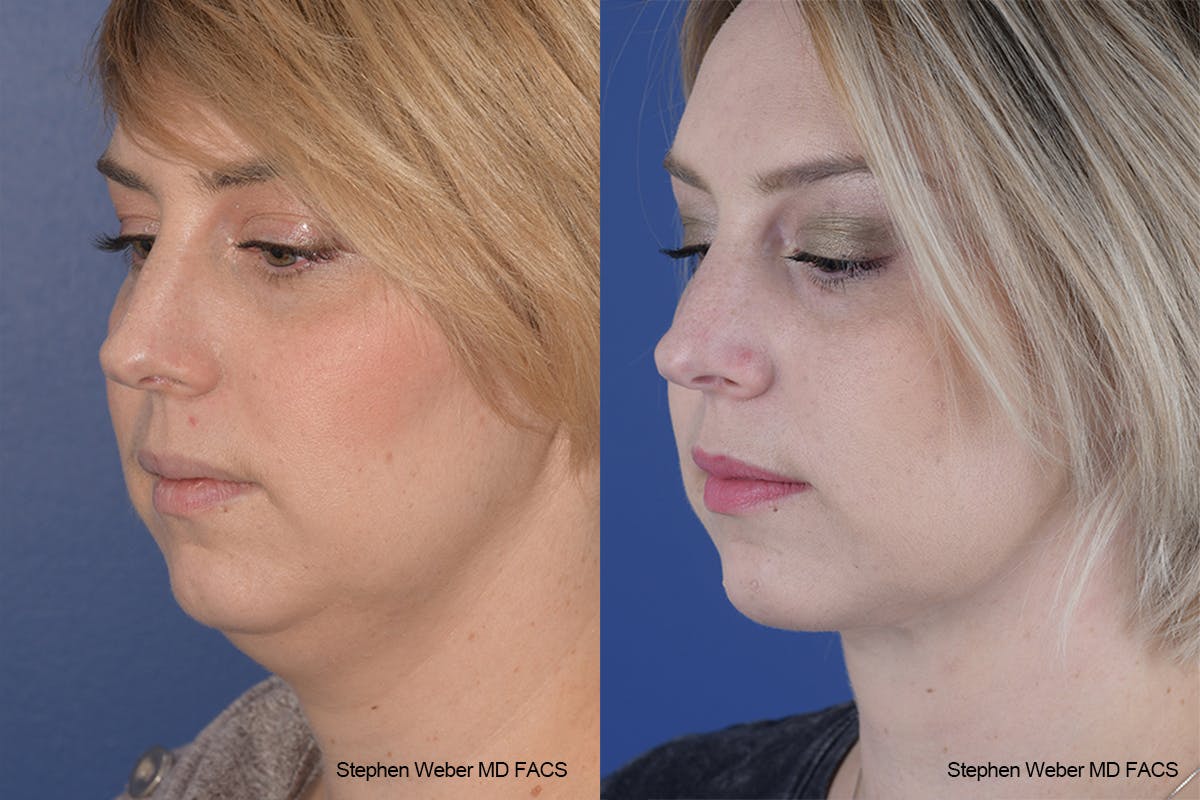 Necklift Before & After Gallery - Patient 332756 - Image 3