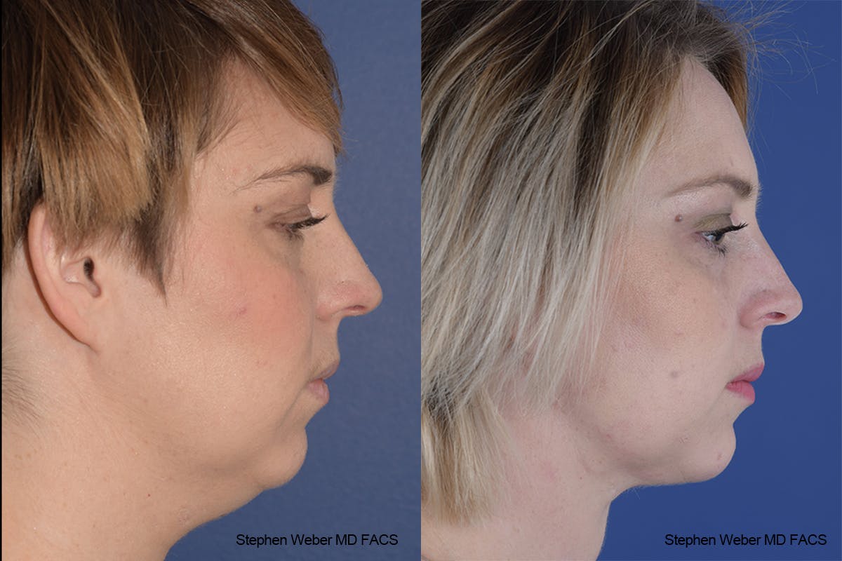 Necklift Before & After Gallery - Patient 332756 - Image 4