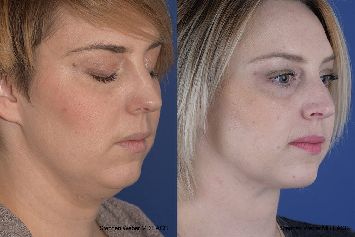 Necklift Before & After Gallery - Patient 332756 - Image 5