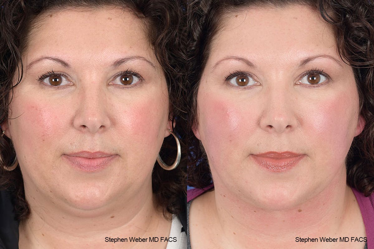 Necklift Before & After Gallery - Patient 883338 - Image 1
