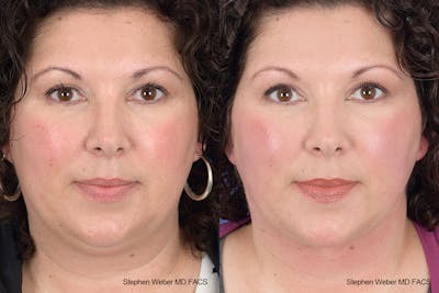 Necklift Before & After Gallery - Patient 883338 - Image 1