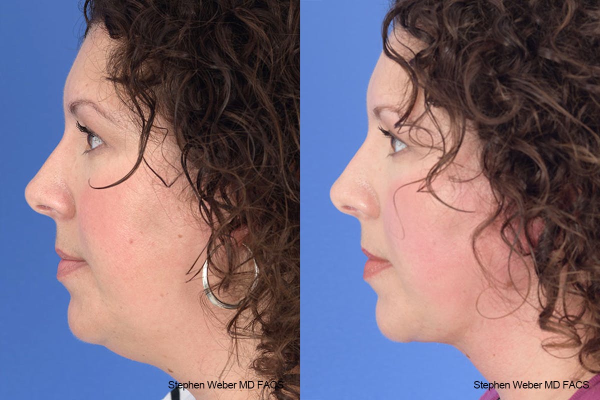 Necklift Before & After Gallery - Patient 883338 - Image 2